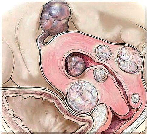 Information on uterine fibroids.