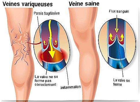 Appearance of varicose veins 
