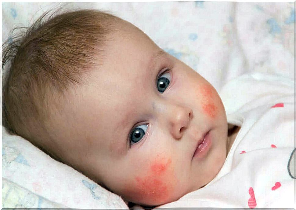A baby with atopic dermatitis
