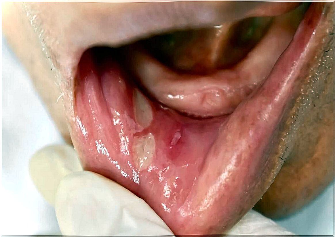 A mouth ulcer.