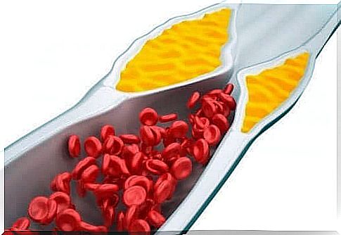 Cholesterol blocking an artery
