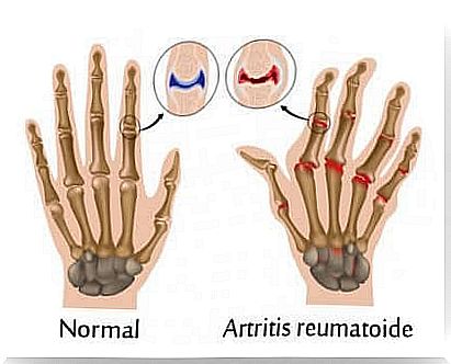 Diagram of hands, normal and with arthritis. 