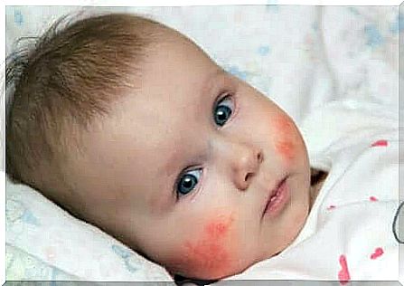 Dermatitis in a baby.