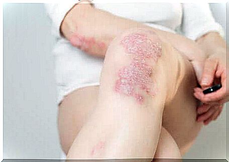 A woman with psoriasis on her knee.