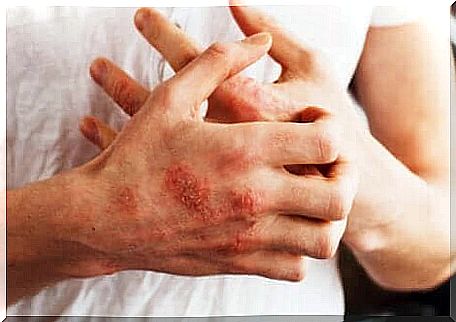 A person with psoriasis and coronary heart disease.