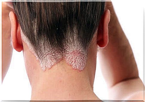 A woman with scalp psoriasis patches