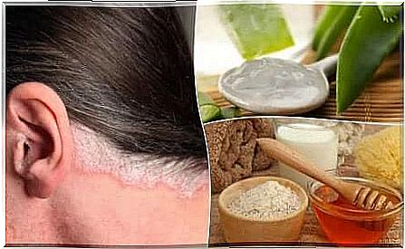 Natural remedies for scalp psoriasis