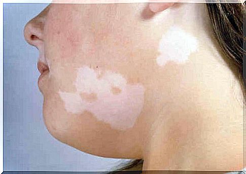 White spots on the skin may indicate vitiligo