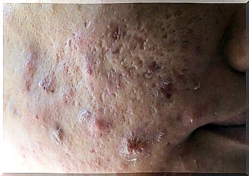 A person with severe acne.