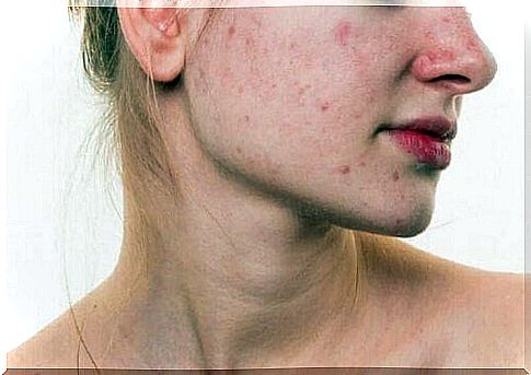 Cystic acne in a woman.